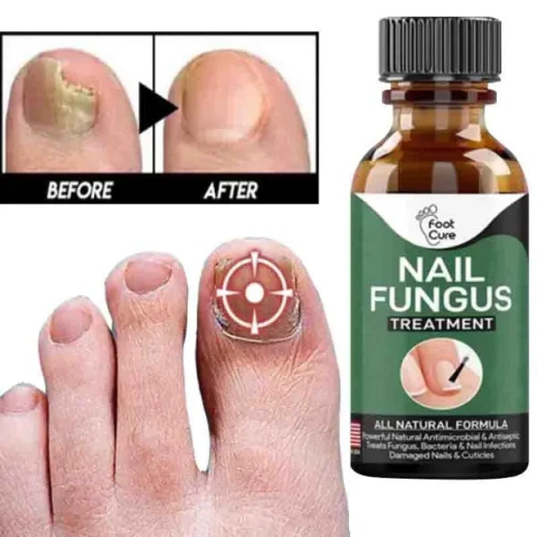 Nail Fungus Treatment Serum | Fast Nail Repair Essence Gel for Healthy & Strong Nails