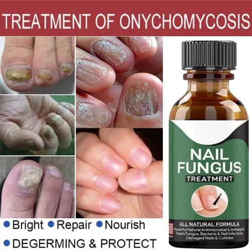 Nail Fungus Treatment Serum | Fast Nail Repair Essence Gel for Healthy & Strong Nails
